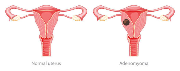 Adenomyoma Adenomyosis Human anatomy Female Sick and normal reproductive system organs. Location scheme Cross section 