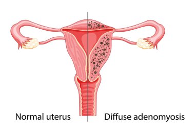 Yaygın Adenomyosis insan anatomisi üremesi. Kadın hasta sistemi normallere karşı, eğitim açısından sağlıklı ikona karşı.