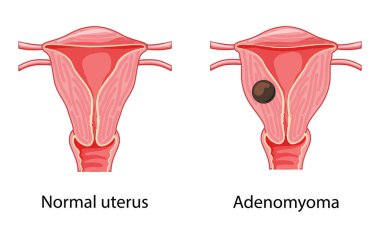 Adenomyoma Adenomyosis insan anatomisi dişi üreme hastalığı ve normal sistem organları. Konum şeması uterus simgesi
