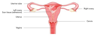 Asherman sendromu kadın üreme sistemi yara dokusu yapışıklığı rahim diyagramında yazıtlarla birlikte. Bir kesikte ön manzara. İnsan anatomisi iç organları konum şeması, rahim yumurtalığı düz biçim simgesi