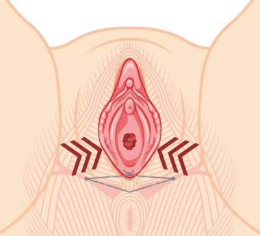 Vaginal lifting with threads Female reproductive system of external genital organs. Front view. Human Surface anatomy of the perineum vulva external organs location scheme, vagina flat style icon clipart
