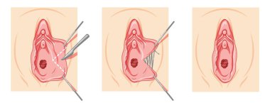 Labiaplasty Female reproductive system process and ready uterus. Vaginoplasty Front view. Human Surface anatomy of the perineum external organs location scheme, vagina pain vulva flat style icon