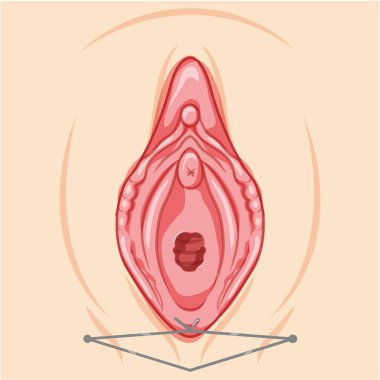 Vaginal lifting with threads Female reproductive system of external genital organs. Front view. Human Surface anatomy of the perineum vulva external organs location scheme, vagina flat style icon