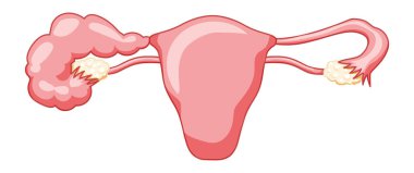 Hidrosalpinx kadın üreme sistemi, tanımlama metniyle dölyatağı tüp uterusunu bloke etti. İnsan anatomisi iç organları vektör tıbbi illüstrasyon düz biçim simgesi beyaz arka planda izole