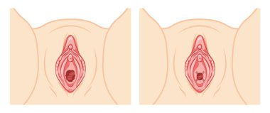 Hymenoplasty before and after Hymen repair restoration revirginization reproductive system uterus. Front view. Human Surface anatomy of perineum external organs scheme, vagina vulva flat style icon