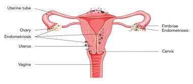 Latince yazıtları olan dişi üreme sistemi rahim diyagramı. Bir kesikte ön manzara. İnsan anatomisi iç organları konum şeması, rahim ağzı, yumurtalık, fallop tüpü düz stil ikonu izole edildi