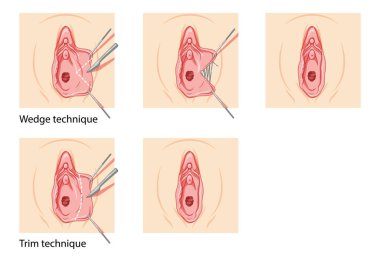 Labiaplasty Female reproductive system process and ready uterus. Vaginoplasty Front view. Human Surface anatomy of the perineum external organs location scheme, vagina pain vulva flat style icon