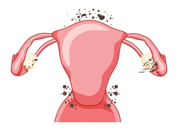 Endometriose Estágio Sistema Reprodutor Feminino Dor Pcos Tecido Câncer Útero — Vetor de Stock