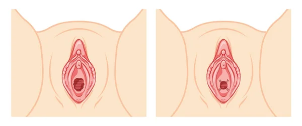 Hymenoplasty Hymen Repair Restoration Revirginization Reproductive System Uterus Front View — Wektor stockowy