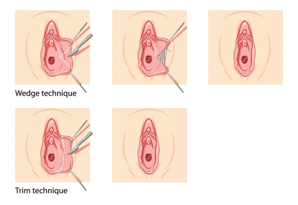 Labiaplasty Female reproductive system process and ready uterus. Vaginoplasty Front view. Human Surface anatomy of the perineum external organs location scheme, vagina pain vulva flat style icon