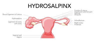 Hydrosalpinx kadın üreme sistemi tanımlama metniyle dölyatağı tüp uterusunu bloke etti. İnsan anatomisi iç organları vektör vektör medikal illüstrasyon düz biçim beyaz arkaplan izole