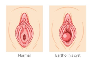 Bartholins cyst gland Female reproductive system uterus. Female Sick vs normal organs. Human Surface anatomy of perineum external organs location scheme, vagina pain vulva blockage flat style icon clipart