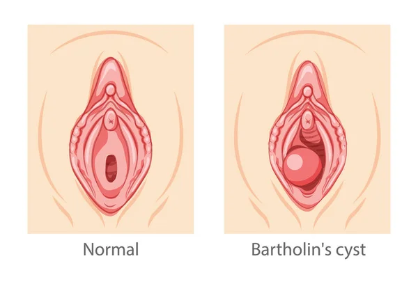 Bartholins Cyst Gland Female Reproductive System Uterus Female Sick Normal — ストックベクタ