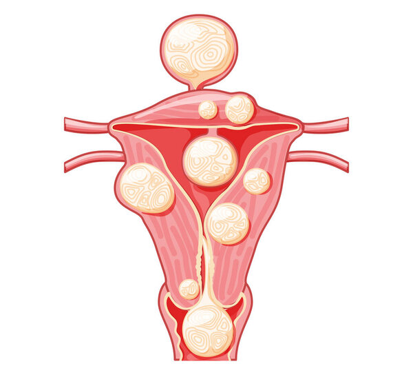 Set of Uterine fibroids Female leiomyomas reproductive system uterus in different styles and cross sections. Front view in a cut. Human anatomy medical illustration isolated internal organs flat icon