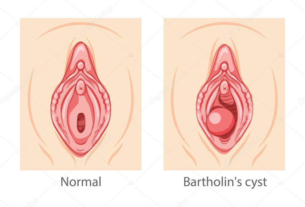 Bartholins cyst gland Female reproductive system uterus. Female Sick vs normal organs. Human Surface anatomy of perineum external organs location scheme, vagina pain vulva blockage flat style icon