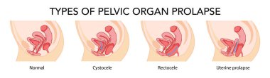 Set of Prolapses types pelvic organ cystocele, uterine, rectocele. Female reproductive system uterus. Human anatomy internal organs location scheme flat. Vector medical illustration concept isolated