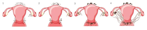 Набір Ендометріозу Стадії Жіноча Репродуктивна Система Біль Рак Кіста Матки — стоковий вектор