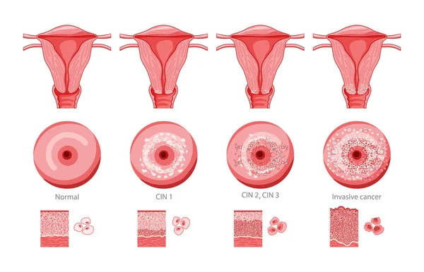 Servikal invaziv kanser intraepitel neoplazi displazi 12.3 ve rahim kanseri infografi testi infografik üreme sistemi Carcinoma görüntüsü üzerinde normal hücre morfolojisi. tıbbi düz biçim