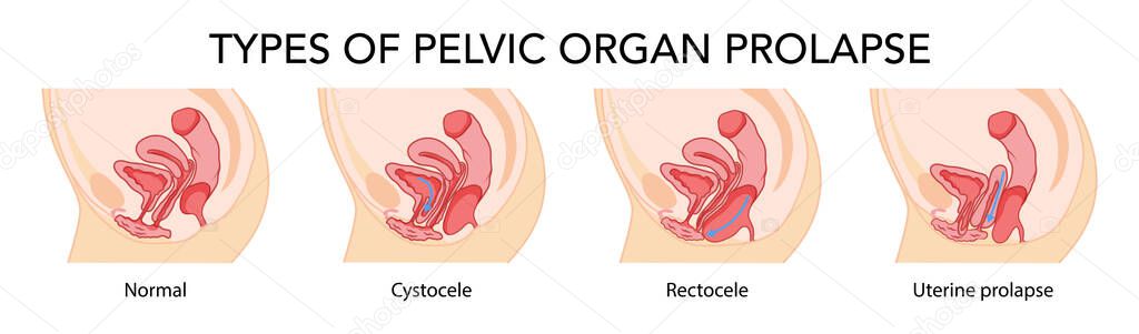 Set of Prolapses types pelvic organ cystocele, uterine, rectocele. Female reproductive system uterus. Human anatomy internal organs location scheme flat. Vector medical illustration concept isolated