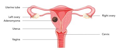 Adenomyoma Adenomyosis ile yazıtlar, insan anatomisi üreme hastalıkları sistemi organları. Latince metinde rahim, rahim ağzı, yumurtalık, fallop tüpü yapısı. Ön görünüm Vektör illüstrasyonu