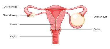 Yumurtalık kisti dişi üreme sistemi uterusu Latince yazıtlarla birlikte anatomik bilgi diyagramında. İnsan anatomisi iç organları konum şeması, rahim ağzı, yumurtalık, fallop tüpü düz simgesi