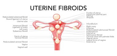 Rahim fibroidi olan kadın leiomyoma üreme sistemi rahim diyagramı Latince metinlerde yazılıdır. İnsan anatomisi tıbbi illüstrasyonu iç organları izole etti konum şeması düz biçim simgesi