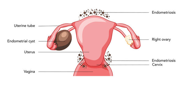 Ovarian endometriomas chocolate cysts Female reproductive system uterus problem diagram with inscriptions. Human medical anatomy internal organs location scheme flat icon vector illustration isolated