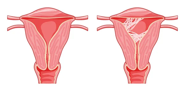 Набор Синдрома Ашермана Склеивание Рубцовой Ткани Женской Репродуктивной Системы Матке — стоковый вектор