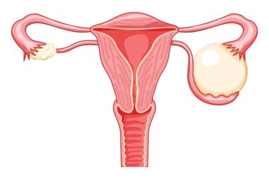 Yumurtalık kisti kadın üreme sistemi uterusu anatomik bilgisinde. Kesik jinekolojik bir hastalığın ön yüzü. İnsan anatomisi iç organları konum şeması fallop tüp düz biçim ikonu