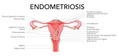 Endometriyozis, dişi üreme sistemi acı rahim diyagramını yazıtlarla birlikte aşamalar. Ön manzara. İnsan anatomisi iç organları düz biçim ikon vektör çizimi Gerçekçi düz izole