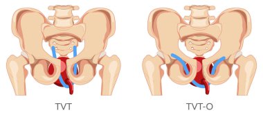 Set of Urinary incontinence tension free vaginal tape TVT versus transobturator tape TOT for female stress urinary incontinence therapy Female system is skeleton pelvis. Human anatomy flat icon