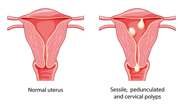 Conjunto Pólipos Útero Sistema Reproductor Femenino Secciones Transversales Enfermedades Normal — Archivo Imágenes Vectoriales