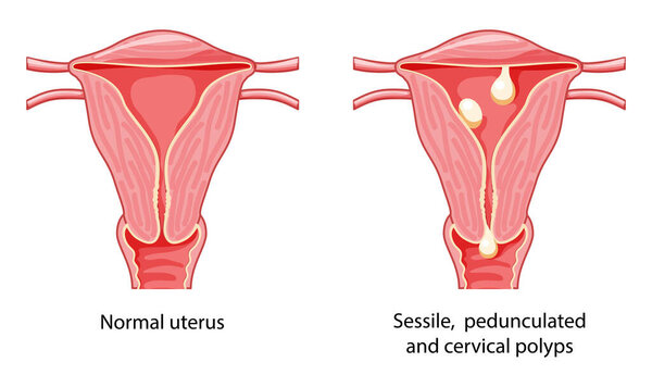 Set of Polyps in the uterus Female reproductive system in cross sections diseases and normal. Front view in a cut. Human anatomy internal organs location scheme, cervix, ovary flat style icon