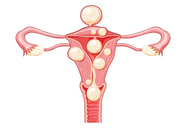 Uterine Fibroids Female Leiomyomas Reproductive System Uterus Front View Human —  Vetores de Stock