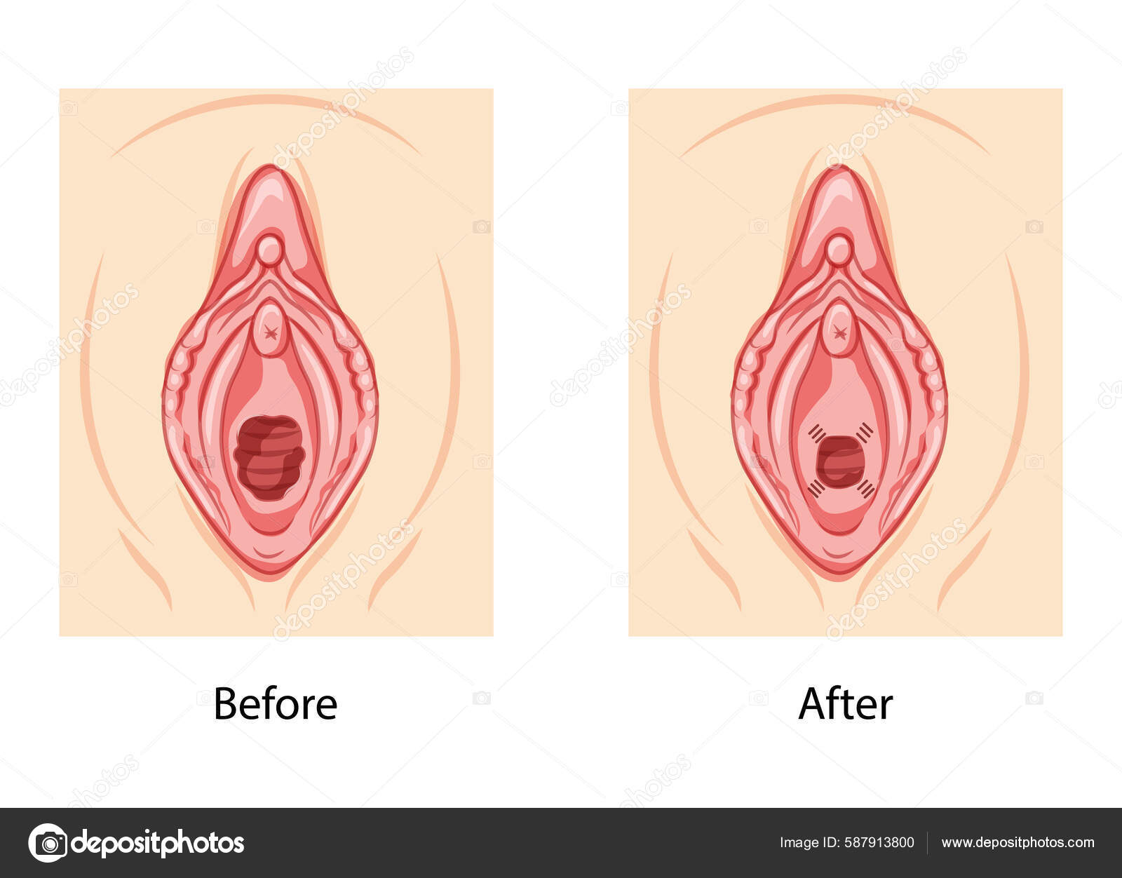hymen 