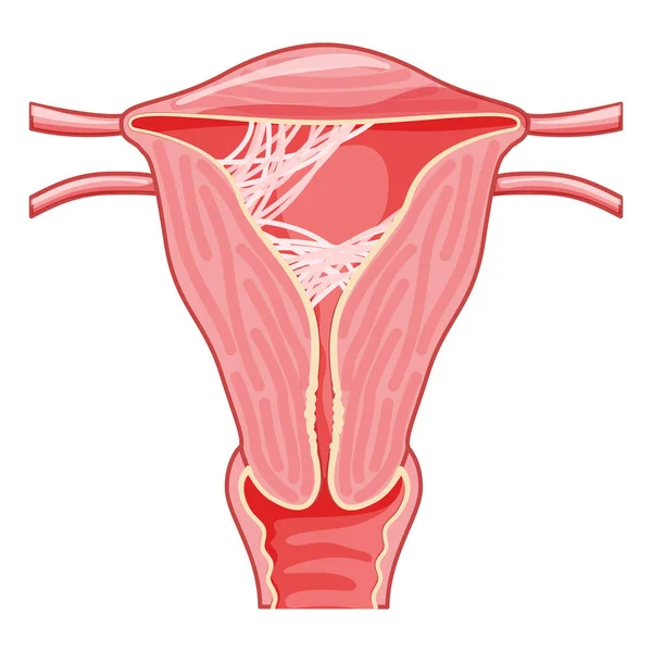 Asherman Syndrome Female Reproductive System Scar Tissue Adhesions Uterus Front — Vettoriale Stock