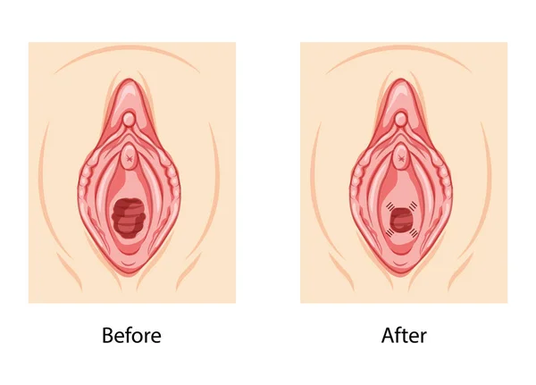 Hymenoplasty Hymen Repair Restoration Revirginization Reproductive System Uterus Front View — Image vectorielle