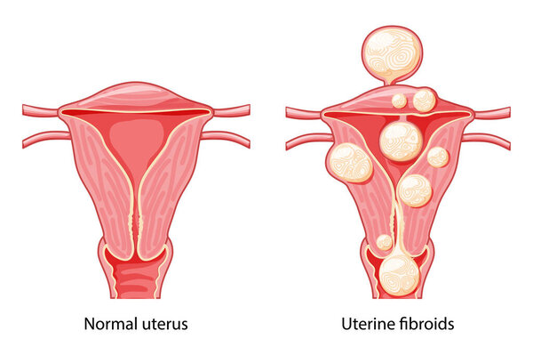 Set of Uterine fibroids Female leiomyomas reproductive system uterus normal and with disease pain. Human anatomy medical illustration isolated internal organs cervix, fallopian tube flat style icon