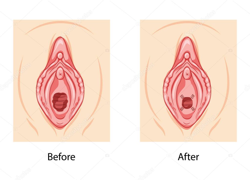 Hymenoplasty before and after Hymen repair restoration revirginization reproductive system uterus. Front view. Human Surface anatomy of perineum external organs scheme, vagina vulva flat style icon