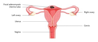Yazıtlarla Odak Adenomyosis, İnsan Anatomisi Kadın Üreme Bozukluğu Sistemleri. Latince metinde rahim, rahim ağzı, yumurtalık, fallop tüpü yapısı. Kesik Vektör illüstrasyonunda ön görünüm