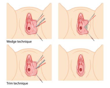 Labiaplasty Female reproductive system process and ready uterus. Vaginoplasty Front view. Human Surface anatomy of the perineum external organs location scheme, vagina pain vulva flat style icon