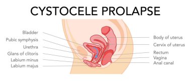 Metni yazılı olan kadın üreme sistemi rahmini prolapse cystocele. Yan bakış İnsan anatomisi iç organları konum şeması düz biçim ikonu. Vektör tıbbi illüstrasyon renk kavramı izole edildi