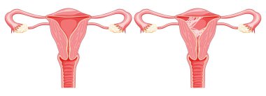 Asherman sendromu kadın üreme sistemi rahim içinde yara dokusu adhezyonu. Bir kesikte ön manzara. Hasta ve normal insan anatomisi iç organları konum şeması, rahim ağzı, yumurtalık yassı biçim ikonu