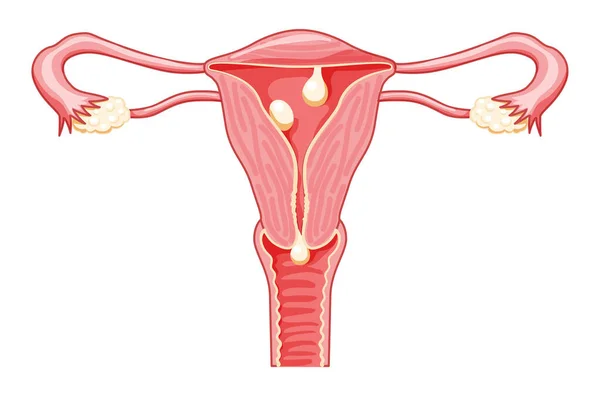 Rahimdeki polipler, servikal, peddüküle edilmiş ve enine kesitlere ayrılmış dişi üreme sistemi. Bir kesikte ön manzara. İnsan anatomisi hastalıkları iç organ konum şeması düz biçim simgesi