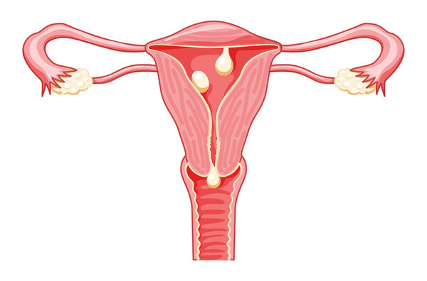 Polyps in the uterus - cervical, pedunculated and sessile Female reproductive system in cross sections. Front view in a cut. Human anatomy diseases internal organs location scheme flat style icon