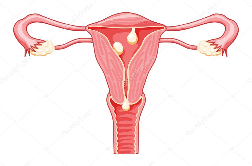 Polyps in the uterus - cervical, pedunculated and sessile Female reproductive system in cross sections. Front view in a cut. Human anatomy diseases internal organs location scheme flat style icon