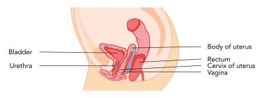 Anatomik bilgiyle etiketlenmiş rahim içi prolapse kadın üreme sistemi rahim. Bir kesikte yan görünüş. İnsan anatomisi iç organları konum şeması düz simge. Vektör tıbbi illüstrasyon