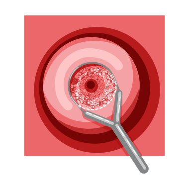 Electrocoagulation diathermy of the cervical dysplasia cancer infographic Female reproductive system Carcinoma uterus. Front view in cut. Human anatomy internal organs location scheme flat style icon