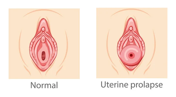 Dölyatağı prolapse kadın üreme sistemi. Perinyum rahim normal ve hastalıklı kadınlar. İnsan anatomisi dış organları düz stil simgesi. Vektör tıbbi illüstrasyon kavramı izole edildi