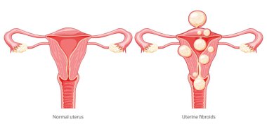 Rahim içi fibroidi seti kadın leyomyomları üreme sistemi rahim normal ve hastalık ağrısı var. İnsan anatomisi medikal illüstrasyon izole edilmiş iç organlar konum şeması, rahim ağzı düz stil simgesi